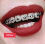 DIY Fashion Braces Kit - Decorative Teeth Alignment Look with Adjustable Brackets - Image 2