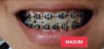 DIY Fashion Braces Kit - Decorative Teeth Alignment Look with Adjustable Brackets - Image 4