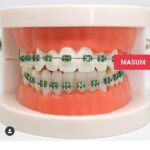 DIY Fashion Braces Kit - Decorative Teeth Alignment Look with Adjustable Brackets