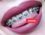 DIY Fashion Braces Kit - Decorative Teeth Alignment Look with Adjustable Brackets - Image 7