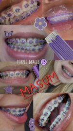 Professional DIY Orthodontic Braces Training Kit – Multi-Color Metal Brackets & Archwire Set