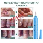 BREYLEE Nail Treatment Serum Feet Care Essence Fungal Nail Foot Repair Removal Gel - Image 2